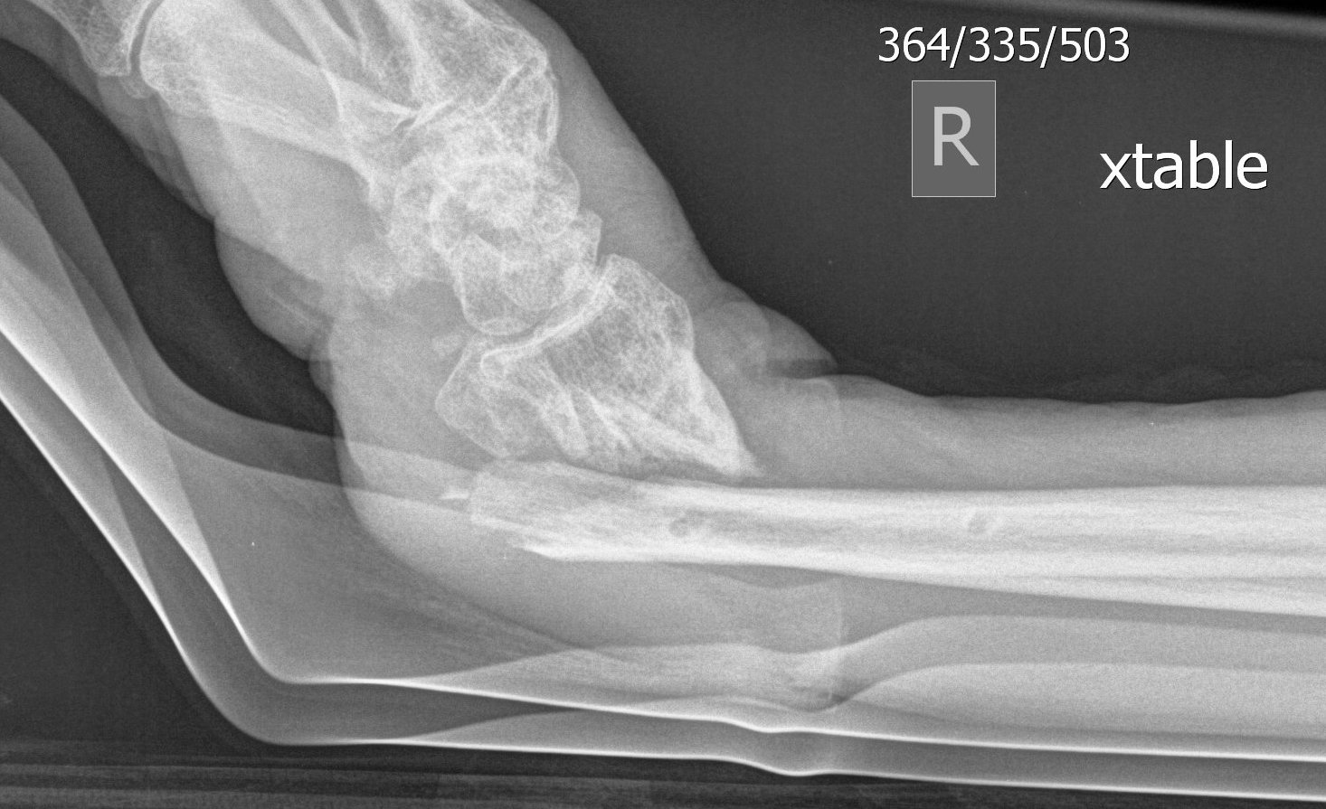 Distal Radius Fracture Severely Displaced.jpg